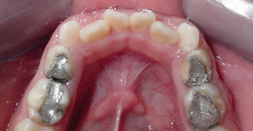 Análisis para determinación de espacio dentario