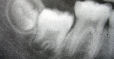 Tercer molar mandibular
